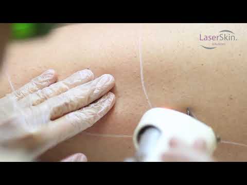 Αποτρίχωση με laser Αλεξανδρίτη στα Laserskin Solutions