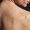 Body Acne Solution laserskin solutions