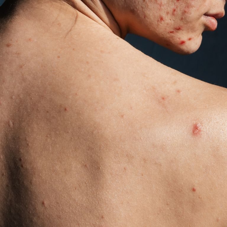 Body Acne Solution laserskin solutions