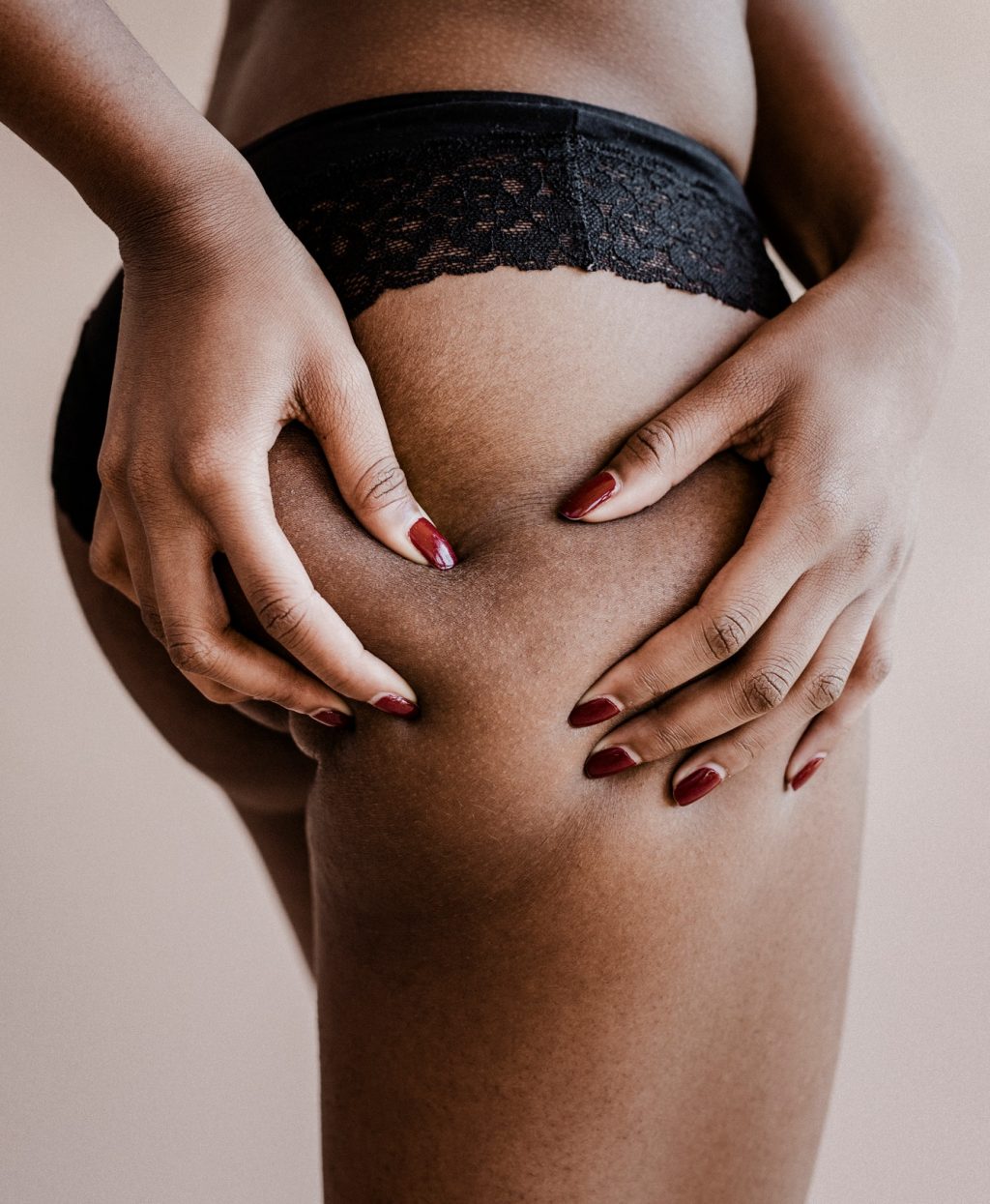 Black woman with cellulite